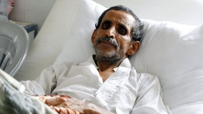 По 5 хил. нови случаи на холера дневно се засичат в Йемен