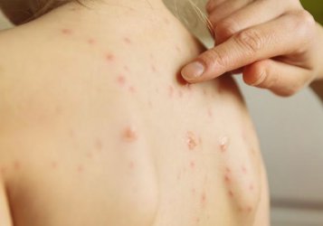 С 460 болни от морбили България е на шесто място по брой заразени в Европа