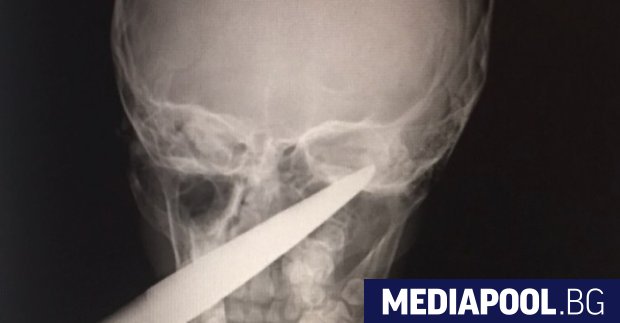 Седемгодишно момче със забита в главата градинска ножица беше спасено