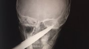 В бургаската болница спасиха дете със забита в главата градинска ножица