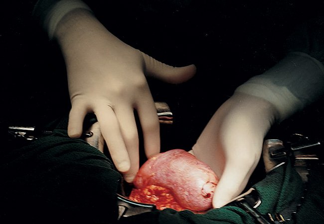 Все повече българи се подлагат на нелегални трансплантации в Турция