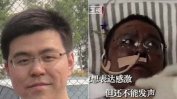 Китайски лекари, спасени от коронавирус, са се събудили от кома с потъмняла кожа