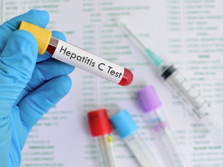 Диагностицирането на хепатит С изостава тревожно