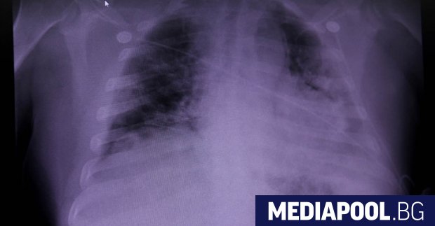 Изследване на белите дробове на хора починали от Covid 19 установи