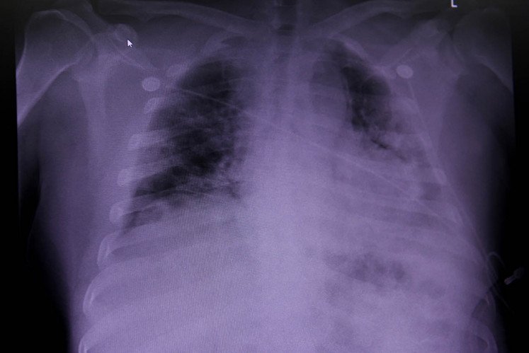 Увреждане на белите дробове може да обяснява продължителния Covid