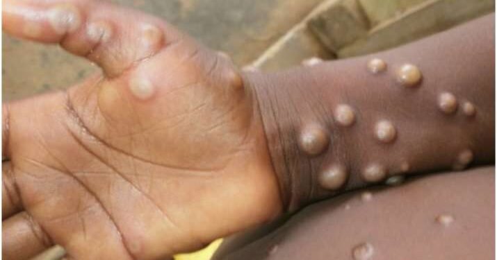Африка няма нито доза ваксина срещу маймунска шарка, макар че там са всички смъртни случаи от болестта