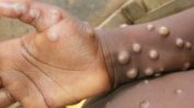 Африка няма нито доза ваксина срещу маймунска шарка, макар че там са всички смъртни случаи от болестта