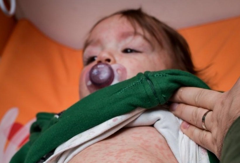 Има риск от взривове от морбили в София заради спада във ваксинирането