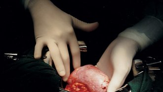 Мъж се възстановява след трансплантация на бъбрек от прасе