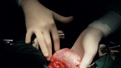 Мъж се възстановява след трансплантация на бъбрек от прасе
