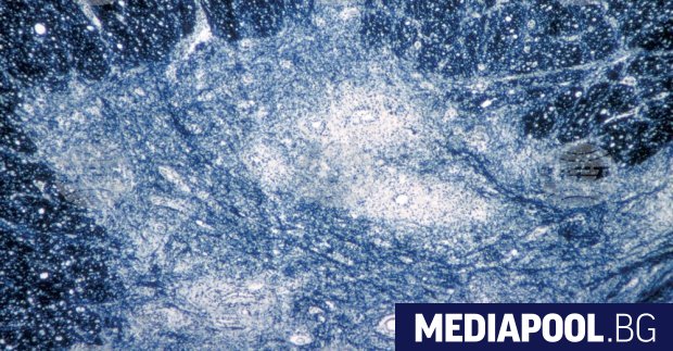 Дива форма на полиомиелит беше открита в проба от германска