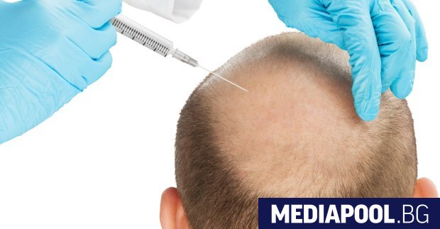 Трансплантациите на коса вече не са просто въпрос на суета