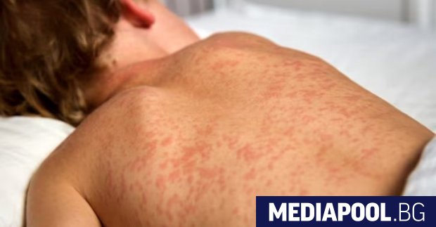 Децата заразени с морбили в община Бяла Слатина са вече