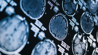 Смятани за революционни лекарства срещу Алцхаймер се оказват силно надценени